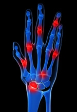 mains-articulations-polyarthrite rhumatoïde