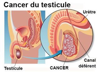 Cancer testicule