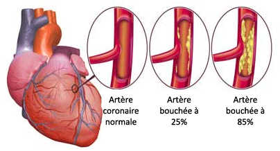 artère coronaire 1
